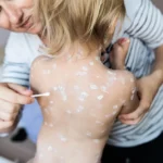 little girl with chickenpox antiseptic cream appl 2024 10 21 21 41 39 utc