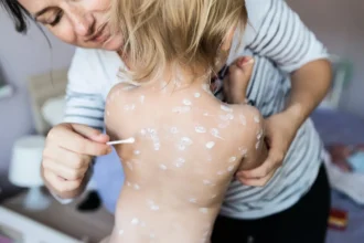 little girl with chickenpox antiseptic cream appl 2024 10 21 21 41 39 utc