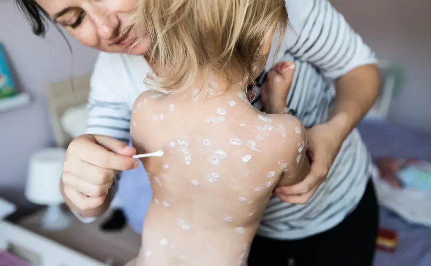 little girl with chickenpox antiseptic cream appl 2024 10 21 21 41 39 utc